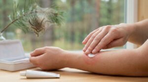 Une personne applique de la crème apaisante sur une piqûre rouge au bras, avec un nid de chenilles processionnaires en arrière-plan.